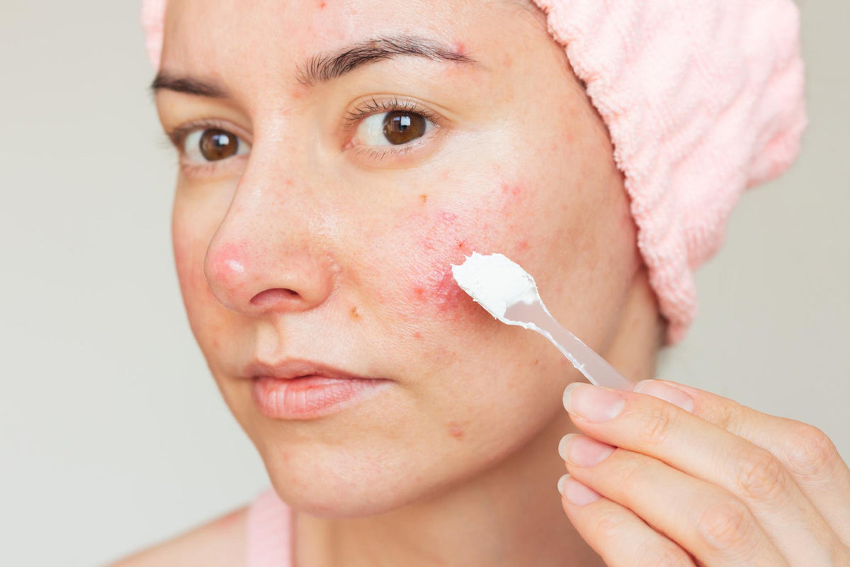 Natural Acne Solutions Australia: Evidence-Based Treatments That Work